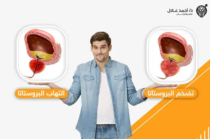 الفرق بين التهاب البروستاتا وتضخم البروستاتا