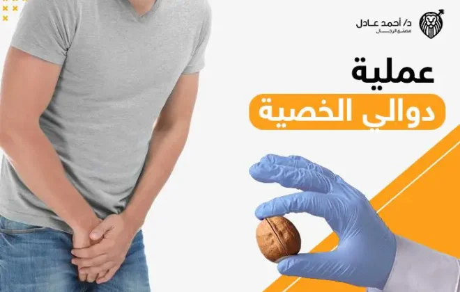 عملية دوالي الخصية